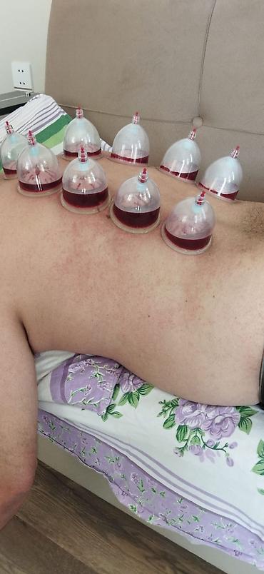 Hicama, zəli: HİCAMA EDİRƏM 30 AZN bankalar 1 dəfəlikdir sonra atilir 1 seansa 7 — 8