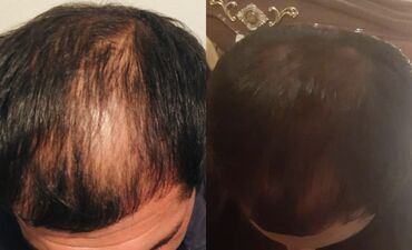 биотин для волос цена бишкек: Уникальное средство против выпадения волос, Сыворотка эффективно