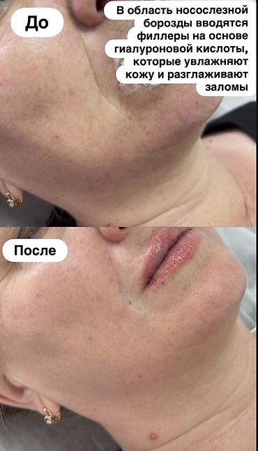 xcomp kg: Косметология, Увеличение губ, Консультация — 5