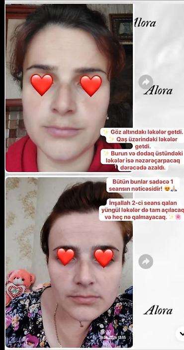 devit 3: ☀️ GÜNƏŞ LƏKƏLƏRİ VƏ ÇİLLƏR SƏNİ NARAHAT EDİR? 🌸 Üzündəki ləkələrə — 2