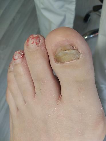 Маникюр: Коррекция вросших ногтей, Педикюр, Услуги подолога, Консультация, Одноразовые расходные материалы — 2