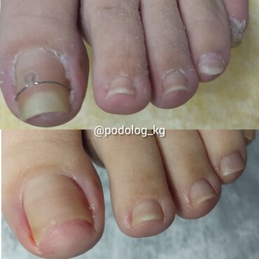 Маникюр, педикюр: Коррекция вросших ногтей, Маникюр, Педикюр, Услуги подолога, Консультация — 11