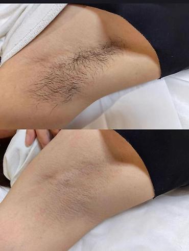 Эпиляция: Восковая депиляция для женщин и мужчин Подмышки - 500 сом — 4