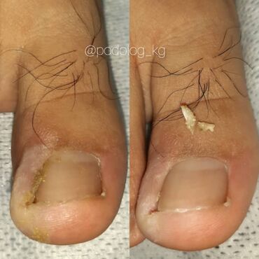 Маникюр, педикюр: Коррекция вросших ногтей, Маникюр, Педикюр, Услуги подолога, Консультация — 9