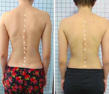 массажист в бишкеке: Массаж | Лечебный массаж | Остеохондроз, Межпозвоночная грыжа, Протрузия | Консультация