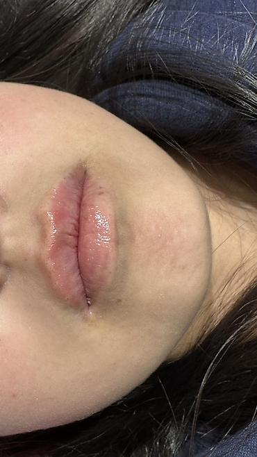 Косметология: Косметология, Увеличение губ, Гипоаллергенные материалы at lalafo.kg — 20 Косметология: Косметология, Увеличение губ, Гипоаллергенные материалы — 20