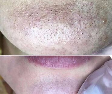 Эпиляция: Город Ош Шугаринг Ош 🔥 Ваксинг Ош 🔥 Всех зон 🔥 Все материалы — 4