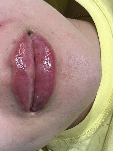 Косметология: Косметология, Увеличение губ, Гипоаллергенные материалы at lalafo.kg — 29 Косметология: Косметология, Увеличение губ, Гипоаллергенные материалы — 29