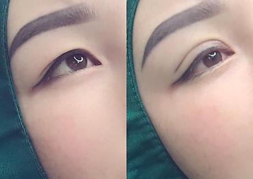 Косметология: Жип менен сурма чыгарабыз, операциясыз, кесилбейт, Оорубайт, шрам — 8