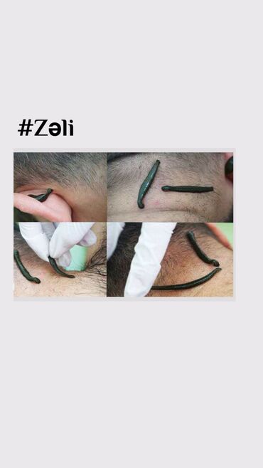 Hicama, zəli: Hicamanın Faydaları✅ *Qan dövranın pozulması *Qanın təmizlənməsi — 10