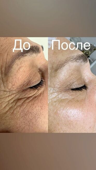 Косметология: Косметология, Пилинг, Ботулинотерапия, Плазмолифтинг, Консультация, Требуются модели, Сертифицированный косметолог — 6