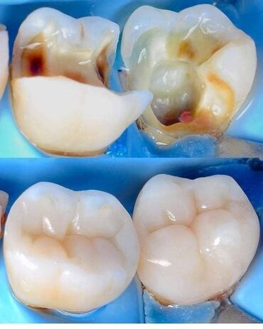 стоматологическое литейка в Кыргызстан | МЕДИЦИНСКОЕ ОБОРУДОВАНИЕ: Стоматолог | Реставрация, Протезирование, Чистка зубов | Консультация, Круглосуточно