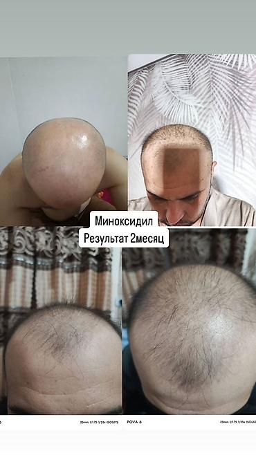 алопеция: Миноксидил Kirkland Signature — средство для стимуляции роста волос — 8