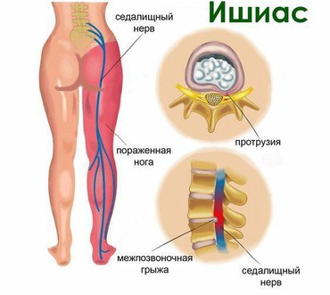 медикаментозный аборт: Массаж | Лечебный | Смещение позвонков