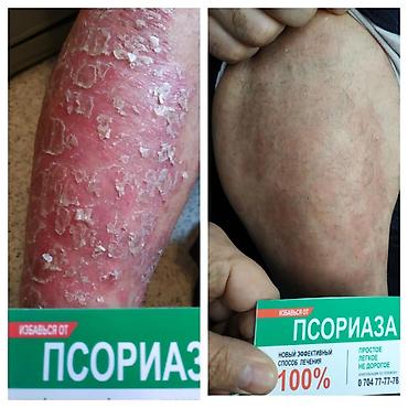 мазь cortam: Здравствуйте! Найден эффективный способ от Псориаза. Я сам болею этой — 4