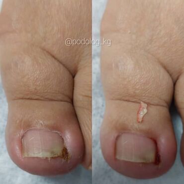 Маникюр, педикюр: Коррекция вросших ногтей, Педикюр, Услуги подолога, Консультация, Одноразовые расходные материалы — 5