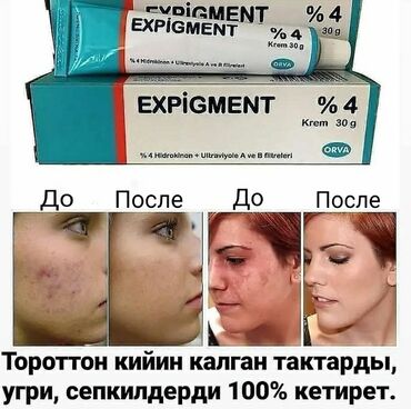крем для отбеливания кожи и устранения пигментных пятен: Крем Expigment (гидрохинон) отбеливает веснушки, возрастные пигментные at lalafo.kg крем для отбеливания кожи и устранения пигментных пятен: Крем Expigment (гидрохинон) отбеливает веснушки, возрастные пигментные
