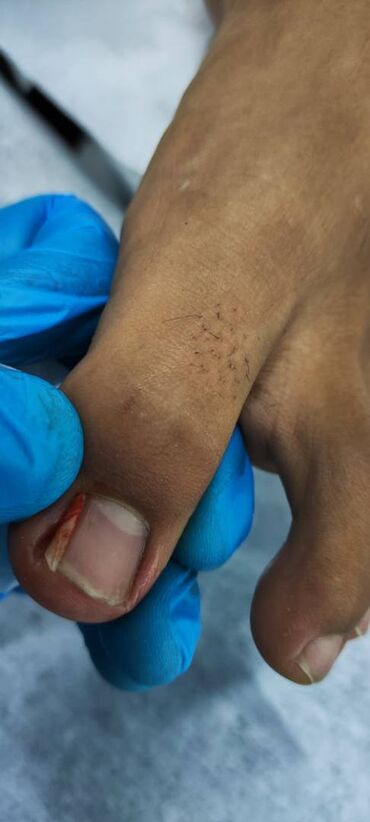 узи почек с выездом на дом: Коррекция вросшего ногтя Обработка стержневых мозолей Обработка