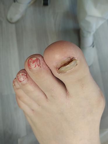 Маникюр: Коррекция вросших ногтей, Педикюр, Услуги подолога, Консультация, Одноразовые расходные материалы — 3