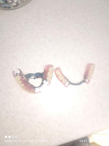 Ортезы: Съемные частичные зубные протезы - Тип: частичные протезы для верхней — 11