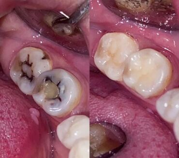художественная реставрация зубов композитными материалами: Адрес: Бишкек, проспект Жибек-Жолу, 215 Чистка 3х этапная 1500 сом