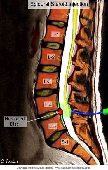 Массаж: Массаж | Остеохондроз, Межпозвоночная грыжа, Протрузия | С выездом на дом, Консультация — 20