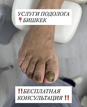 чечим: Ичине кирип өскөн тырмактарды оңдоо, Подолог кызматтары, Консультация — 1