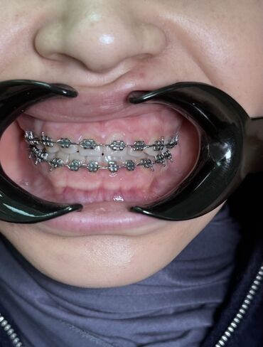 художественная реставрация зубов композитными материалами: Клиника | Стоматолог | Другие медицинские услуги