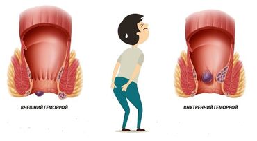 Уход за телом: Мучает геморрой, то мы можем вам помочь ! напишите или позвоните у