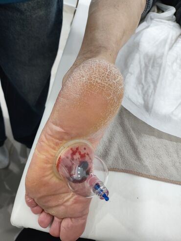 Hicama, zəli: Hicama, quru və yaş vakuum masajı, həmçinin zəli ilə müalicə xidməti — 4