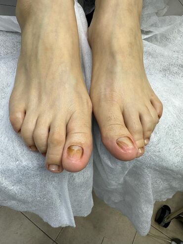 Маникюр, педикюр: Вросший ноготь. Коррекция вросшего сегмента путем удаления врастающих — 7