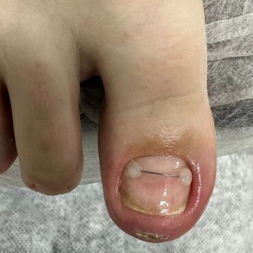 Маникюр, педикюр: Коррекция вросших ногтей, Маникюр, Педикюр, Услуги подолога, Консультация, Одноразовые расходные материалы — 19