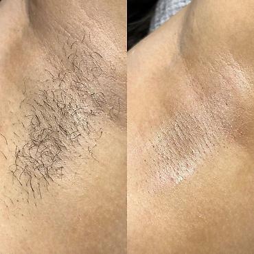 Эпиляция: Восковая депиляция для женщин и мужчин Подмышки - 500 сом — 14