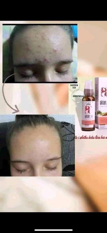 Nega kože: Aknelim gel 30ml – 100% delotvoran saveznik protiv akni Iskoristite — 2