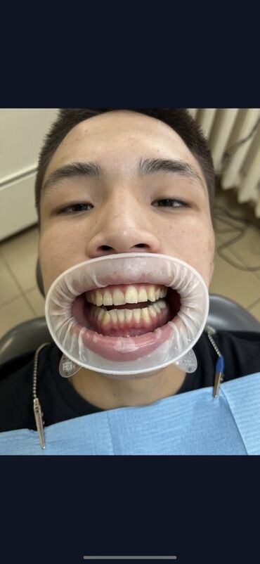 художественная реставрация зубов композитными материалами: Клиника | Стоматолог | Протезирование