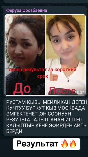 крем без пятен: Фото демонстрирует визуальный результат косметической процедуры для