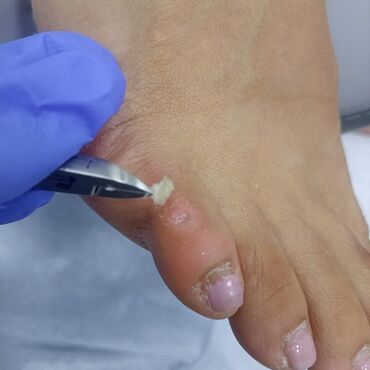 Маникюр, педикюр: Коррекция вросших ногтей, Маникюр, Педикюр, Услуги подолога, Консультация, Одноразовые расходные материалы — 16