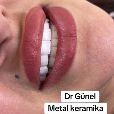 dis: Metal-keramika diş örtükləri, estetik və funksional bərpa üçün ideal
