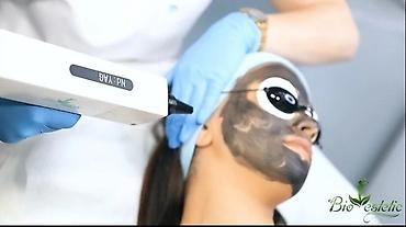 Gözəllik və estetika avadanlığı: Carbon Lazer, Carbon peeling Digər aparatlardan fərqi effektli və — 3