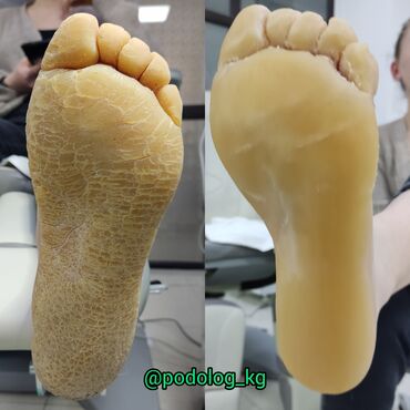 Маникюр, педикюр: Коррекция вросших ногтей, Маникюр, Педикюр, Услуги подолога, Консультация — 12