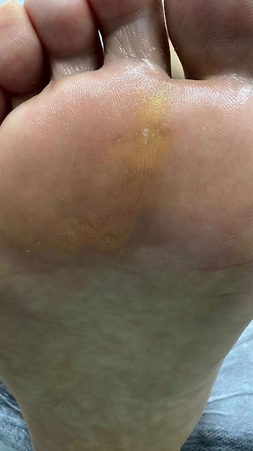 Маникюр: 📢акция с ! Вросший ноготь 📍подологический педикюр,👣 📍мозоли — 5