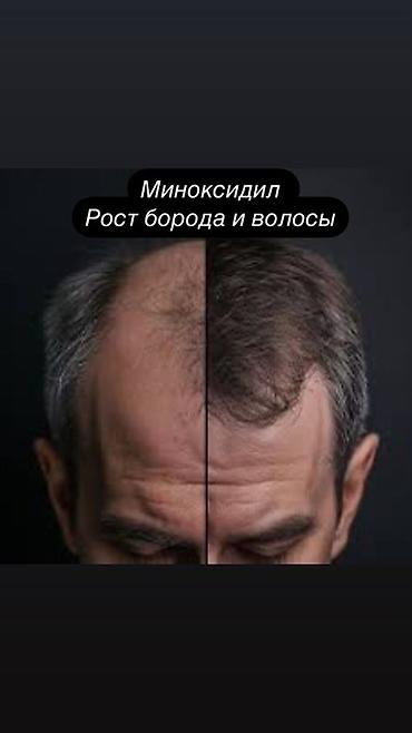 алопеция: Миноксидил Kirkland Signature — средство для стимуляции роста волос — 5