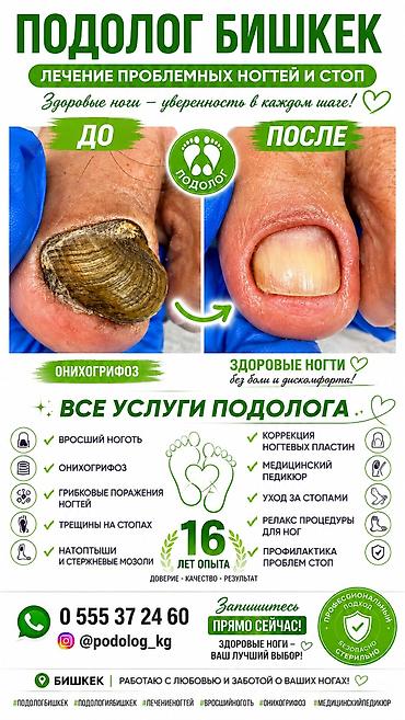 подолог в бишкеке: Коррекция вросших ногтей, Услуги подолога, Консультация — 1