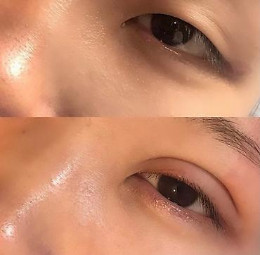 Косметология: Жип менен сурма чыгарабыз, операциясыз, кесилбейт, Оорубайт, шрам — 12