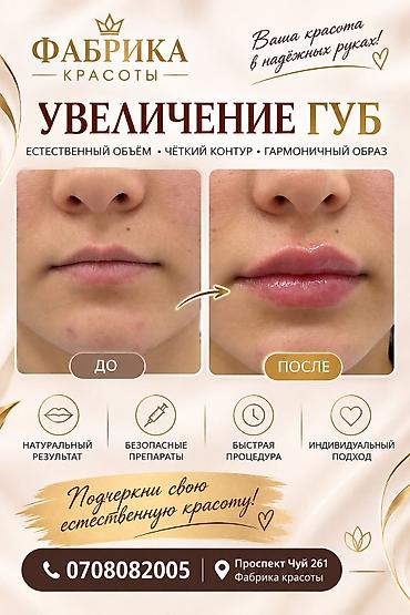 Красота и здоровье: Контурная пластика губ гиалуроновым филлером. - Цель: увеличение — 2