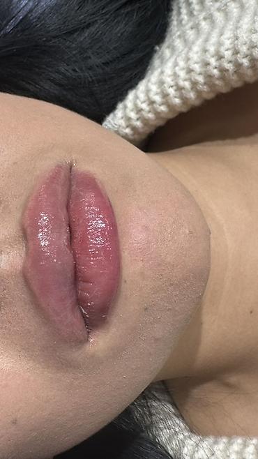 Косметология: Косметология, Увеличение губ, Гипоаллергенные материалы at lalafo.kg — 13 Косметология: Косметология, Увеличение губ, Гипоаллергенные материалы — 13