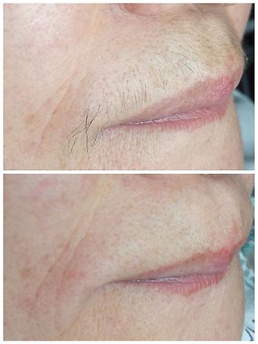 Другие услуги в сфере красоты и здоровья: Тридинг лица Тридинг — 9