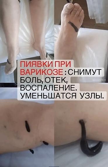 лечение варикоза: Врачи | Гирудотерапевт | Лечение пиявками — 7