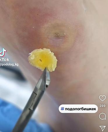 Маникюр: Коррекция вросших ногтей, Услуги подолога, Консультация — 3