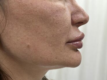 Косметология: Косметология, Ботокс, Биоревитализация, Ботулинотерапия, Консультация, Гипоаллергенные материалы, Сертифицированный косметолог — 38